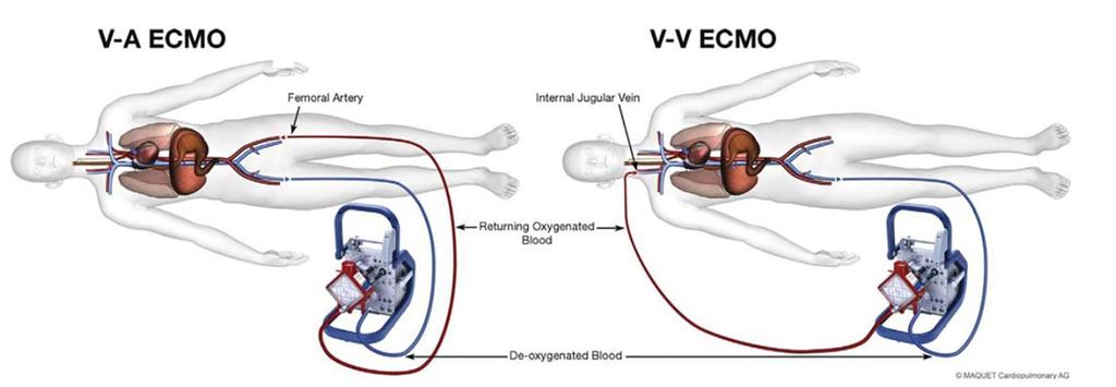 Veno-Venous (Respiratory ECMO)