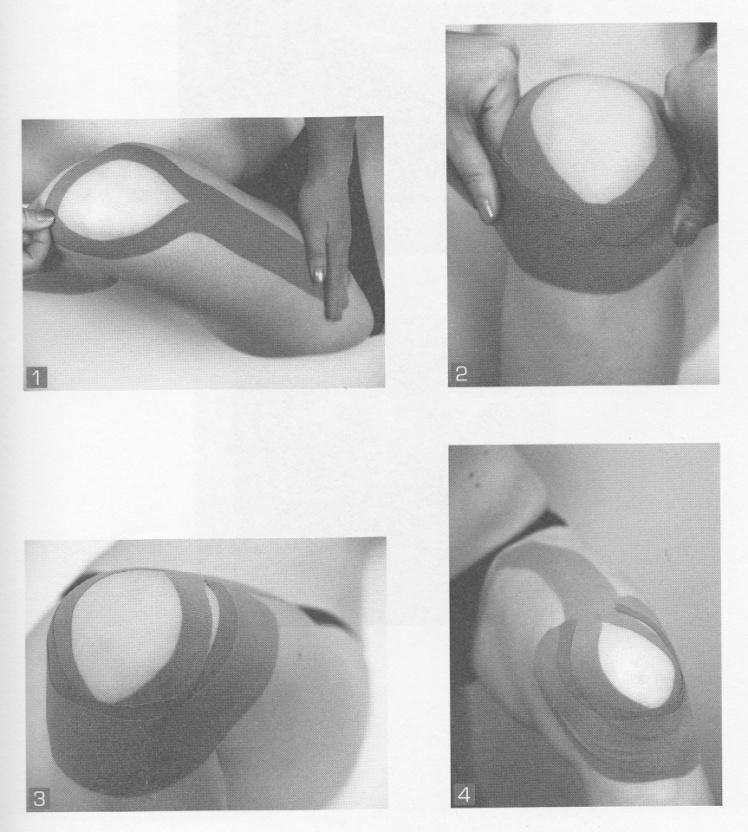 pacient zaujímá polohu v sedu s flektovanou dolní končetinou v koleni. Y tape táhneme od středu svalu m. rectus femoris s obejmutím pately.