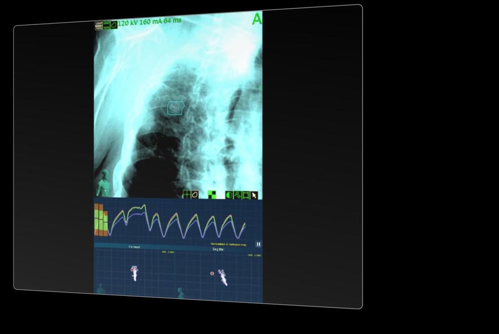 Pořízení dat CyberKnife - Synchrony