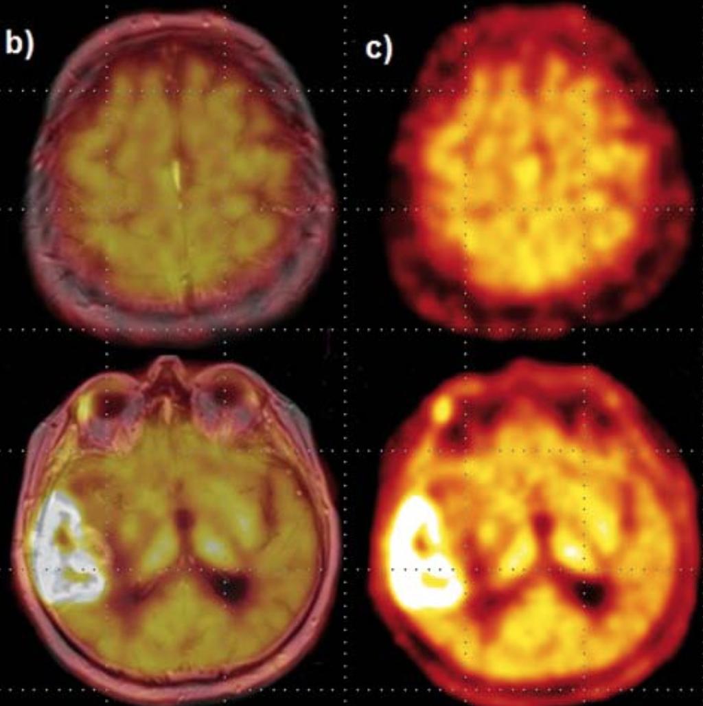 PET v epileptologii a epileptochirurgii největší přínos u pacientů s epilepsií spánkového laloku a b Pacient s obtížně léčitelnou (tzv.