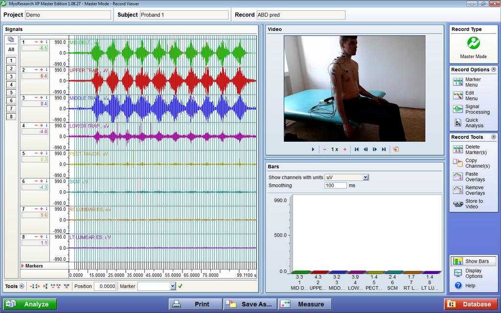 4.7.5 Úprava dat Naměřená neupravená data se zobrazí v programu následovně: Obrázek 6: Surový záznam EMG Program standardně zobrazí EMG signál ze všech sledovaných svalů ve stejném měřítku, tzn.