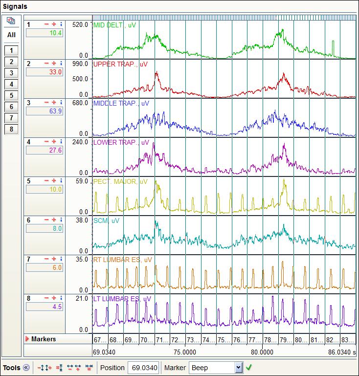 Odstranění EKG signálu Filtr pro redukci EKG nakonec při zpracovávání dat použit nebyl, protože znehodnocoval výsledky. Filtr standardně odstraňuje vliv EKG.