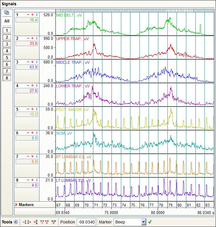 Odstranění EKG signálu Filtr pro redukci EKG nakonec při zpracovávání dat použit nebyl, protože znehodnocoval výsledky. Filtr standardně odstraňuje vliv EKG.