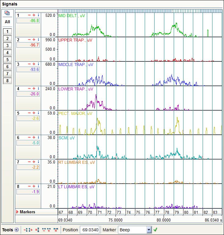 Obrázek 16: EKG signál upravený filtrem ECG Reduction Výběr period Každý proband prováděl testovaný cyklický pohyb 10x, tím jsme získali celkem 10 period pro analýzu.