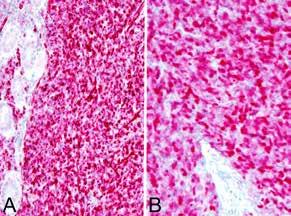 Obr. 4. Kazuistika 1. Difúzní silná cytoplazmatická pozitivita calretininu (A) a nukleární exprese WT1 (B) v nádorových buňkách (IHC, 200x). Obr. 5. Kazuistika 1. FISH analýza interfázních jader s break apart sondou CIC (19q13).