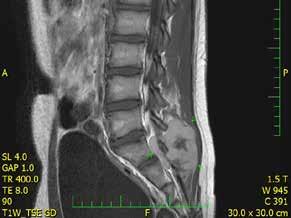 Kazuistika 2 Třináctiletý chlapec operován pro rozsáhlý osteolytický tumor lumbosakrální oblasti s propagací jak extradurálně (s klinickou míšní kompresí), tak do okolních měkkých tkání (obr. 6).
