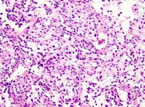 Extenzívní panelová IHC prokázala difúzní nukleární pozitivitu CCNB3 (Sigma Aldrich, polyklonální); veškeré ostatní markery včetně CD99, NKX2, WT1 a calretininu byly kompletně negativní (obr.