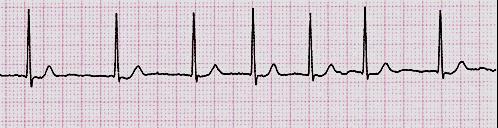 interní klinika VFN Tachykardie se širokými komplexy (QRS > 120ms) Komorová tachykardie Supraventrikulární tachykardie s raménkovou blokádou Komorová tachykardie EKG hodnocení 2.