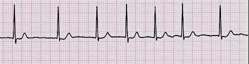 interní klinika VFN Tachykardie se širokými komplexy (QRS > 120ms) Komorová tachykardie Supraventrikulární tachykardie s raménkovou blokádou Komorová tachykardie EKG hodnocení 2.