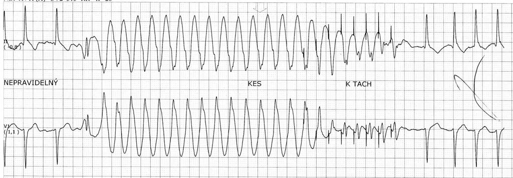 KOMOROVÁ TACHYKARDIE