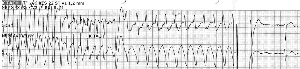 DEFIBRILACE ATP =