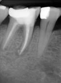 2: Perforace spodiny dřeňové dutiny zubu 46. Na diagnostickém snímku (2a) je viditelná perforace spodiny dřeňové dutiny v místě furkace a výrazné oslabení meziálně.