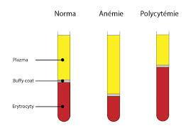 Obrázek 2 Vlevo: Sedimentovaná krev složení Vpravo: stav hematokritu při onemocnění (buffy coat=bílé krvinky a krevní destičky) 2 KREVNÍ SKUPINY 2.