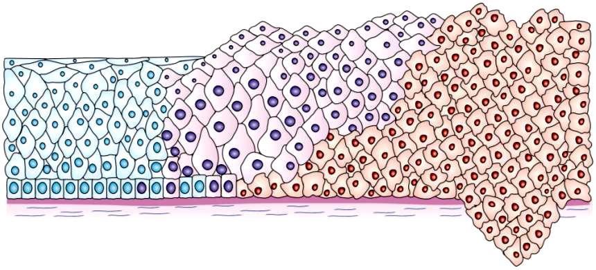 2.2.2. Patogeneze cervikálního karcinomu Prekancerózy vznikající z dlaţdicobuněčného epitelu, se nazývají cervikální intraepiteliální neoplazie (CIN, neinvazivní karcinom), a ze ţlázového epitelu,