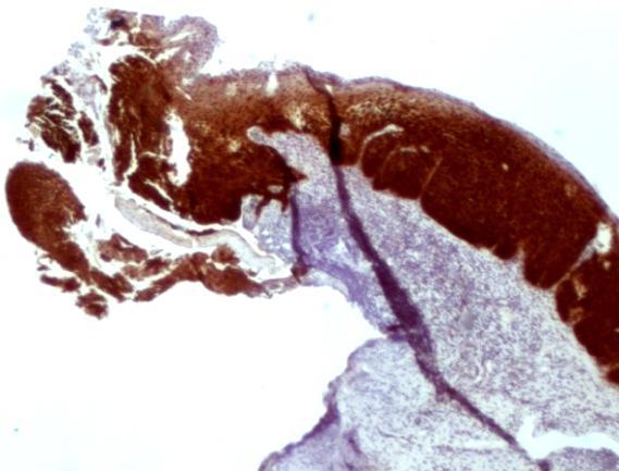 V tomto případě vznikají dysplastické buňky, které vylučují tento protein p 16 v souvislosti s HR HPV infekcí.