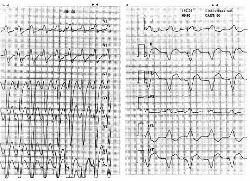 Obrázek 1 Epizoda spontánní komorové tachykardie při arytmogenní destablizaci (vlevo), nucená VVI stimulace z ICD užitá k překlenutí období nestability