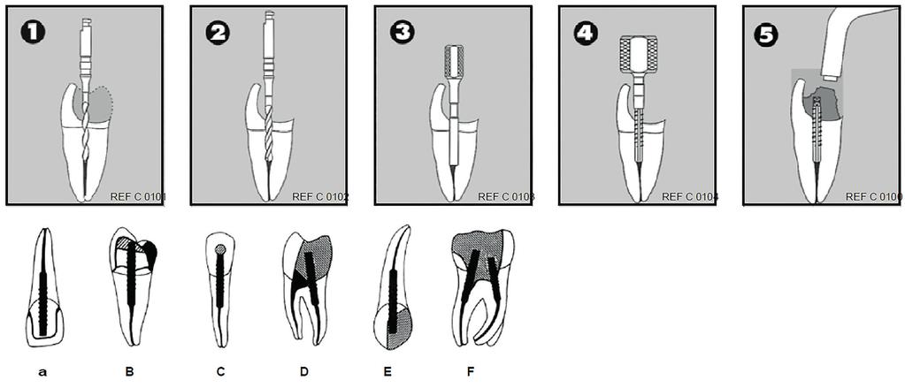 Oblast použití: V případě nedostatečné zbytkové hmoty zubu (< 4 mm) je pro podporu korunkové náhrady třeba použít čep RS Radix-Stifte.