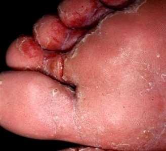 Tinea