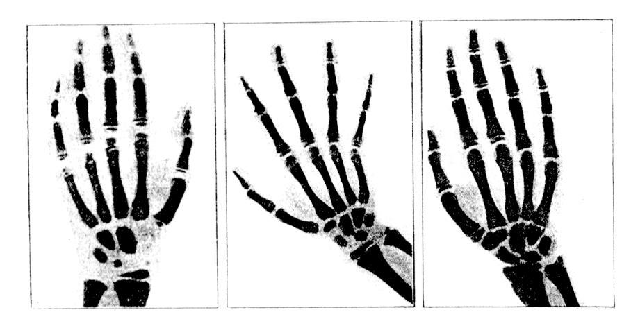 část skeletu, ustálila se však standardizace podle snímků ruky a zápěstí.