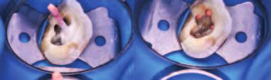 reciprokační preparaci Reciproc blue (VDW) a obturaci GP čep nebo obturátor GuttaFusion (VDW). Natrénujete správnou techniku a vyzkoušíte tipy pro překonání překážek a komplikací.
