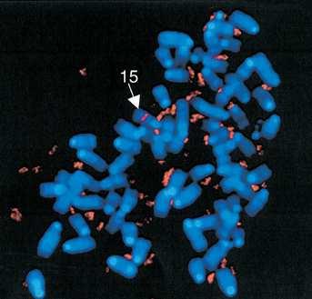 ONKOCYTOGENETIKA příklady typických chromosomových změn - amplifikace genová amplifikace - double minutes (DM) = velmi malé nadbytečné struktury vznik rozpadem HSR - homogeneously stained regions