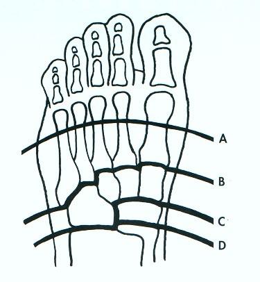 Amputace v oblasti nohy Články prstů Prsty Metatarzy - Sharp B-