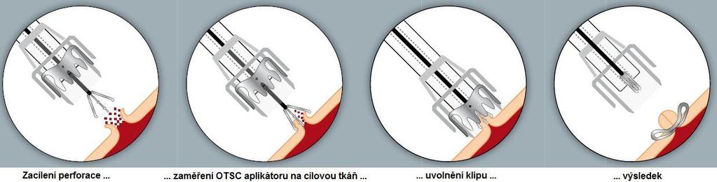 1.2.4 Indikace Využití klipů OTSC v klinické praxi je mnoho a jejich přehled je uveden níže. a) hemostáza nevarikózního krvácení (např.