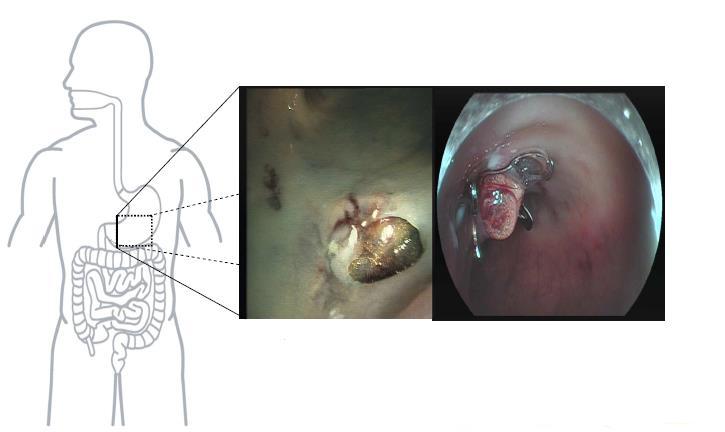 2 Perforace orgánů GIT Perforace orgánů v gastrointestinálním traktu, patří taktéž jako akutní krvácení, mezi velmi závažné příhody břišní
