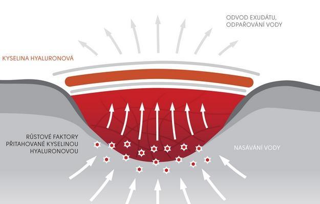 Obrázek č. 4: Princip mokrého (hydrogelového) hojení ran na bázi hyaluronanového hydrogelu [17]. 2.