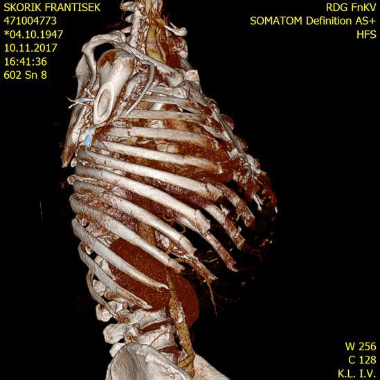 3-D MDCT SNÍMEK BLOKOVÉ