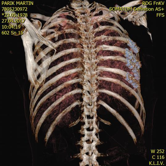 OSTEOSYNTÉZA 4 ŽEBER