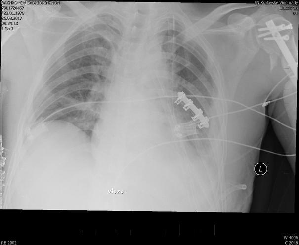 OSTEOSYNTÉZA DLAHOU DISLOKOVANÉHO