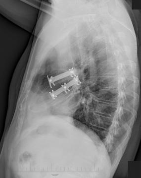 BENEFIT OSTEOSYNTÉZY ŽEBER U BLOKOVÉ ZLOMENINY (RANDOMIZOVANÁ STUDIE TANAKA,H., TRAUMA,2002,LAFFERTY, P.M., JB