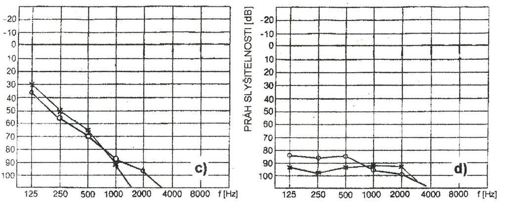 Tónová audiometrie oboustranná