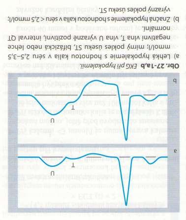 Změny EKG