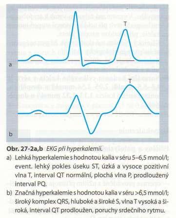 EKG změny