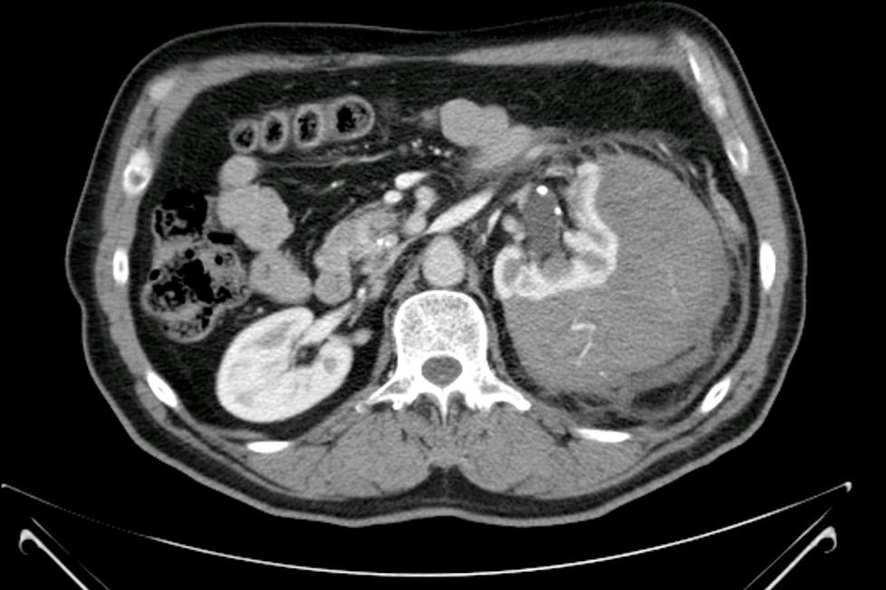 48 ORIGINÁLNÍ PRÁCE Obr. 1. CT vyšetření s patrným hematomem a leakem kontrastní látky z ledviny Fig. 1. CT scan with an apparent haematoma and leakage of contrast medium from the kidney 125/82, P 100/minutu.