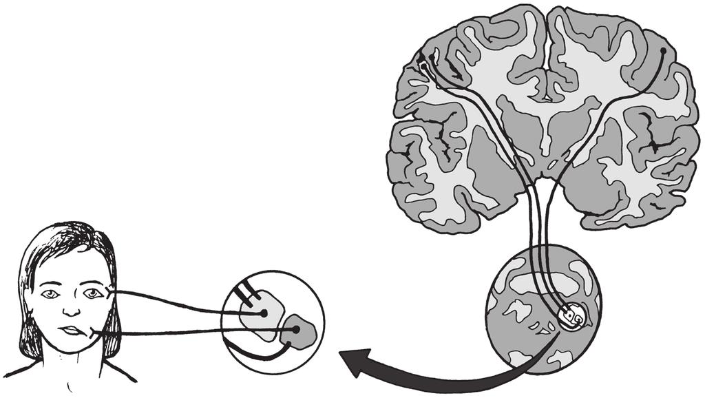 56 Základy neurologie motorický kortex léze vpravo vlevo centrální typ mimické parézy vlevo jádro n. VII. dolní polovina obličeje horní polovina obličeje horní polovina obličeje jádro n. VII. dolní polovina obličeje Obr.