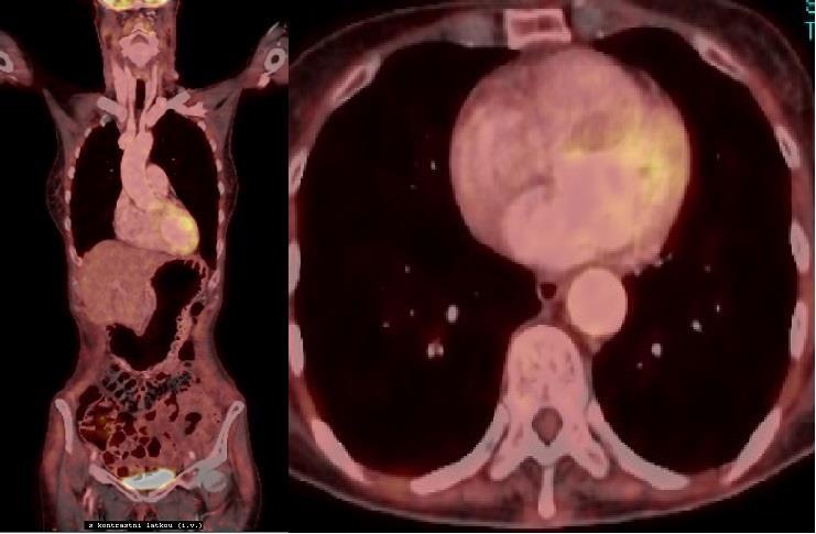 Celotělové PET/CT trupu, akumulace 18 FDG v myokardu Zdroj: WinMedicalc FN