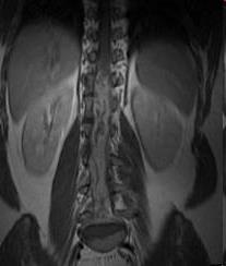 Arachnoiditis Etiologie - konzervační prostředky v místním