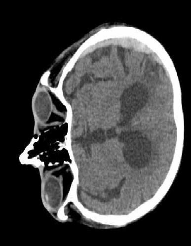 Subdurální hematom Po ztrátě CSM