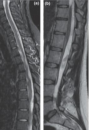 Severe adhesive arachnoiditis resulting in progressive paraplegia following obstetric spinal anaesthesia: a case report and review T Kileen et al.