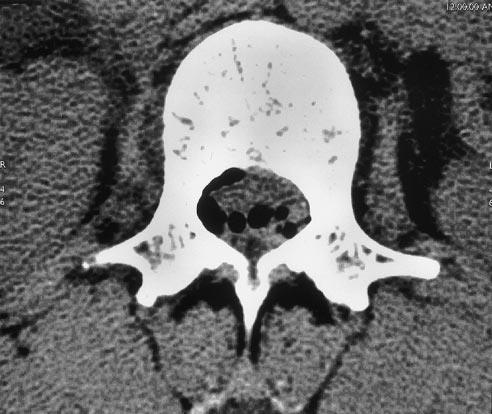 Komprese míchy páteřní hematom Etiologie páteřního hematomu Iatrogenní