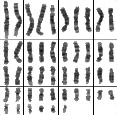 Obrázek 32: Výsledný obraz po segmentaci chromosomů Klasifikace chromosomů do karyotypu Klasifikace chromosomů probíhá pouze na zdravé sestavě chromosomů.