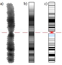 Vyhodnocení karyotypu se zaměřuje pouze na zdravý karyotyp. Pokud je před klasifikací segmentováno 45 chromosomů, je vypsáno, že se jedná o monosomii, ale už není určeno, který chromosom není obsažen.