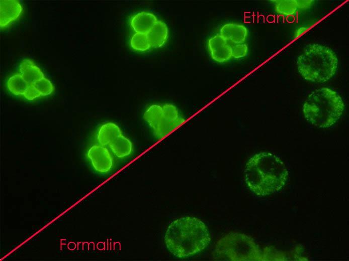 se NIF, k potvrzení se doplňuje ELISA typizace p- ANCA (myeloperoxidáza) c - ANCA (proteináza 3) atypická - ANCA (elastáza, laktoferin, lysozym, katepsin.