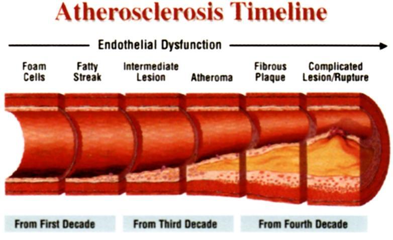Obrázek 2: Schema vývoje aterosklerózy http://www.knowabouthealth.com/glossary-common-heart-disease-terms/1154/ (27. 3. 2013) (59) b) 1. Léze I Změny v histologické stavbě cévy jsou minimální (19).