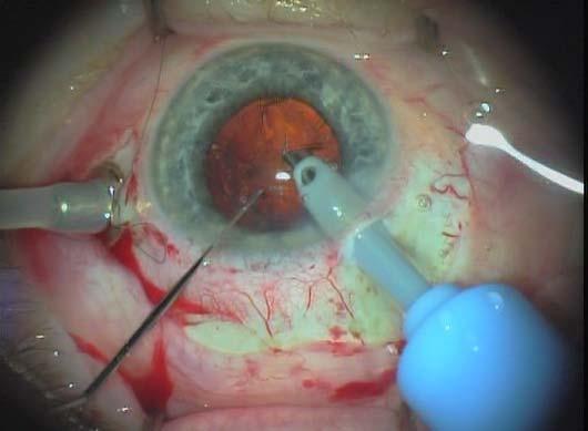 mechanickou stabilitou pro další průběh operace. Následuje hydrodisekce čočky. Vstříknutím tekutiny pod přední pouzdro při okraji capsulorhexe separujeme jádro a kortex čočky a umožníme rotaci jádra.