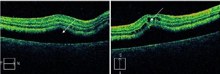 Při vyšetření zadního segmentu oka lze dosáhnout rozlišení až1µm. Podle hodnoty odrazivosti (reflektivity) těchto vln od očních struktur se zbarvuje zobrazený obraz.