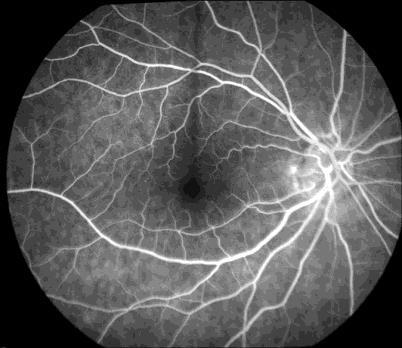 Metodou fluorescenční angiografie jsme schopni zjistit rychlost toku krve nebo odhalit poruchy cévního zásobení sítnice, jako jsou například diabetická retinopatie, uzávěry arterií nebo žil sítnice,